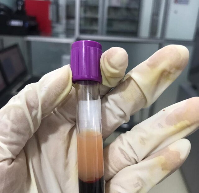 Donor Darah Apheresis